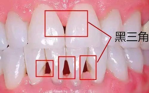 牙龈萎缩程度图片图片