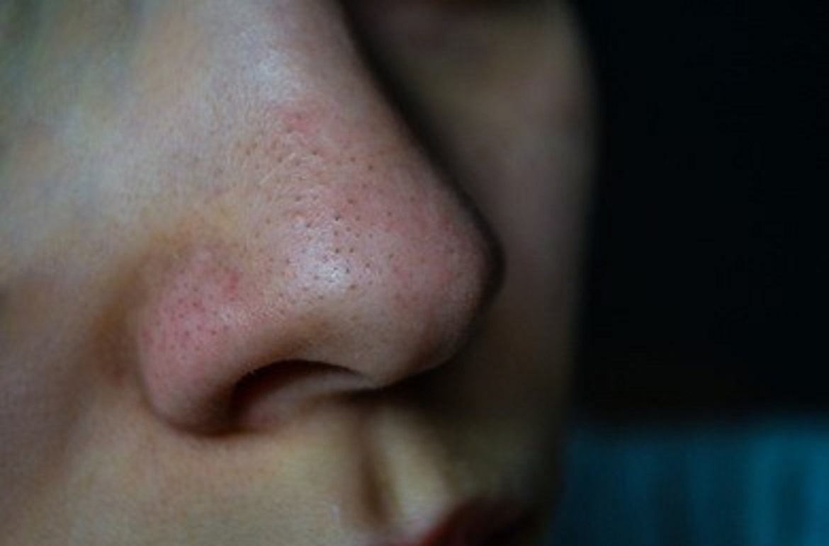 鸡蛋和它一起用竟是黑头收割机陈年草莓鼻被拯救了