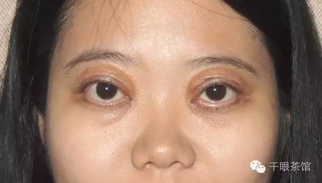 眼皮松弛下垂原因很多