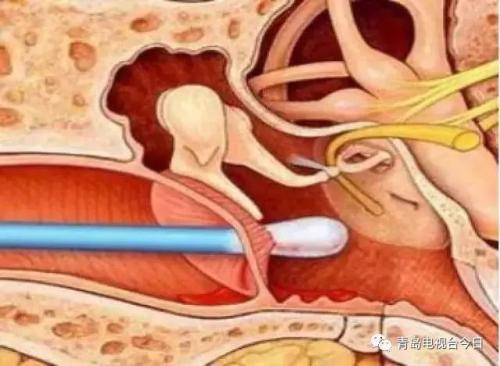 日常导致鼓膜破裂因素 搜狐大视野 搜狐新闻