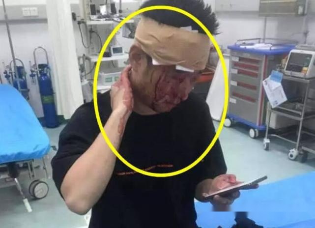 钱小佳粉丝聚会混入黑粉直播时被一个酒瓶砸得头破血流