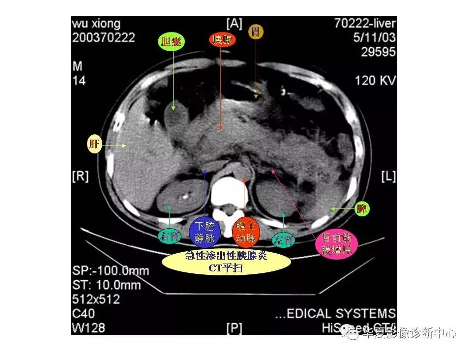 肝脏ct断层解剖图谱图片