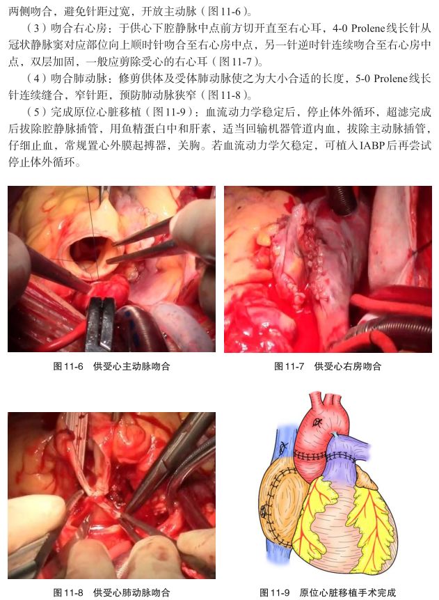 心肺移植科技前沿