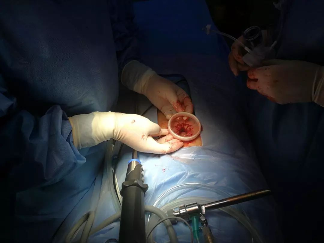 由传统腹腔镜手术的四孔,三孔改为一孔后,对主刀医生在经验和技巧提出