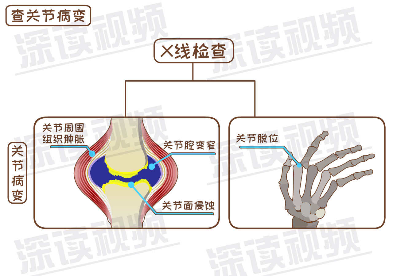 原创类风湿关节炎难治疗盘它