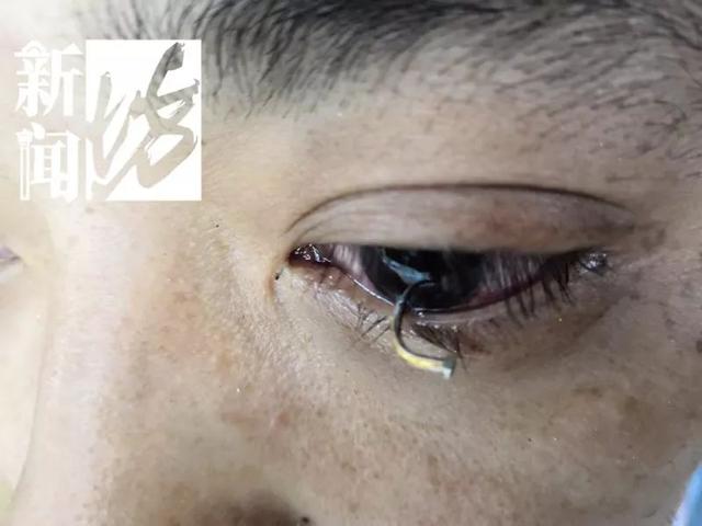 申晨间|真·眼中钉!上海一小伙突然眼前一黑,医生也有点吓到了