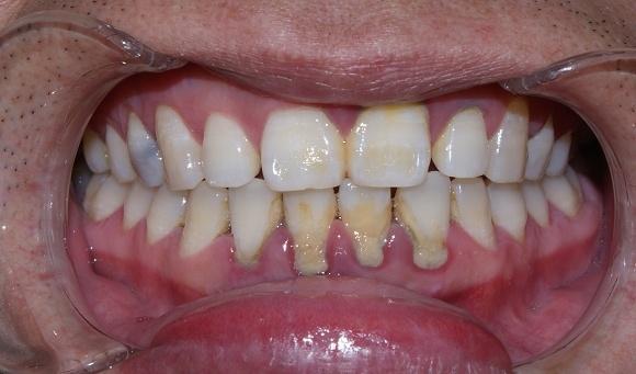 原创牙龈老出血还牙齿发黄是为什么有好的解决办法吗