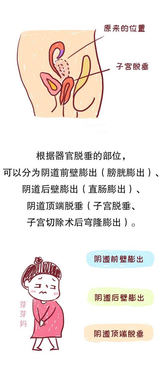 拿什么拯救你产后妈妈的子宫脱垂一个相避也无法避开的问题