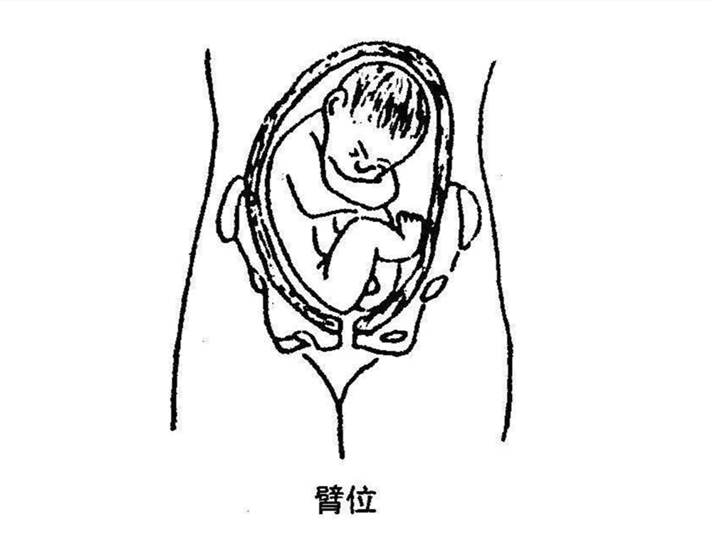 臀位听胎心的位置图图片