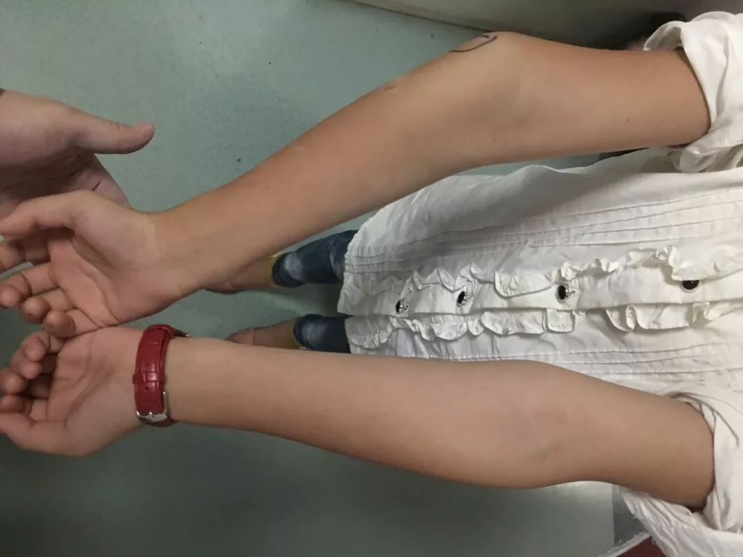 胳膊肘往里拐孩子这种情况不容忽视