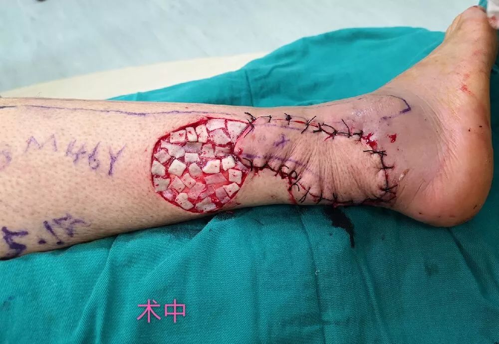 成功为一名患者实施了腓动脉血管体穿支螺旋桨皮瓣修复足跟软组织缺损