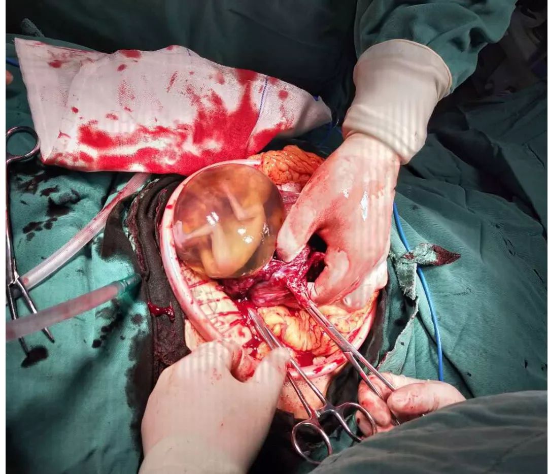 病例分享罕见孕中期出现子宫破裂如何诊断和处理