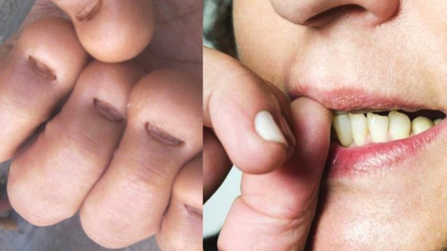 指甲到底有多少细菌显微镜下放大200倍观察看完还敢啃吗