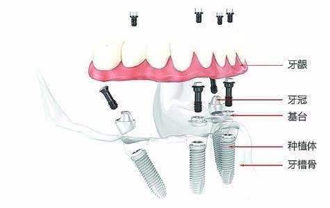 种植牙三期图解 步骤图片