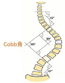 颈椎cobb角图片