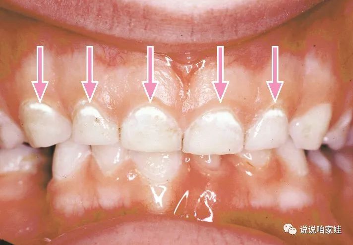 那些认为孩子没蛀牙就不看牙医的父母现在肠子都悔青了