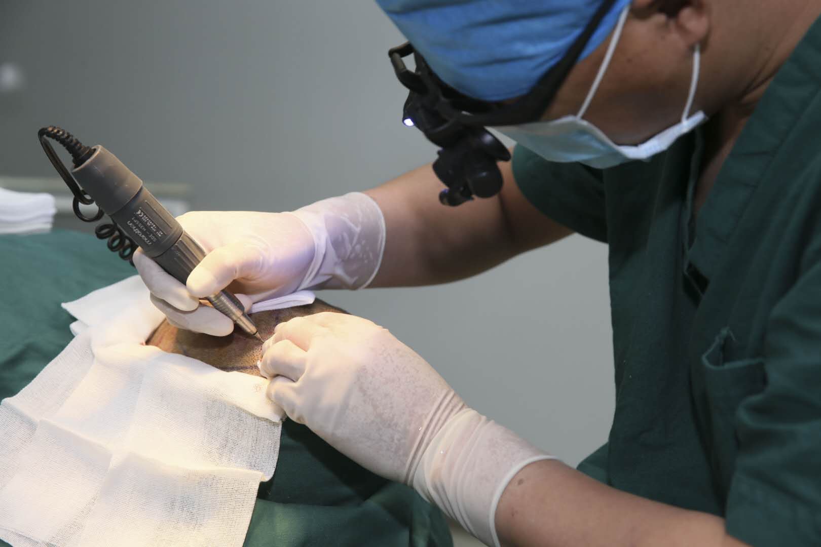 植发成为颜值消费新热点明星效应让植发医生成了香饽饽