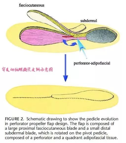 旋髂浅动脉皮瓣设计图图片