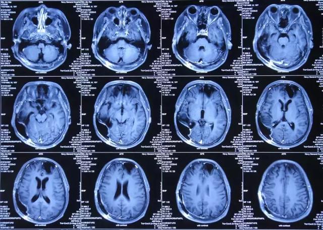 车祸之后遗留癫痫颅骨缺损留下的后遗症能恢复正常吗