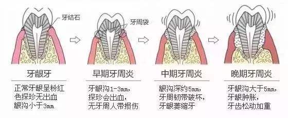 牙龈炎和牙周炎的区别是什么别傻傻分不清了