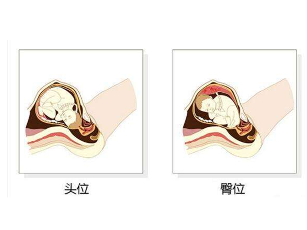 原创辟谣胎儿臀位会影响腿部发育若想顺产纠正胎位是关键