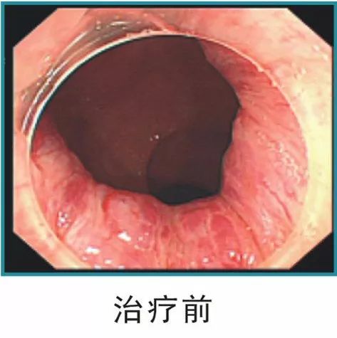 四川省旺苍县人民医院开展内镜下内痔硬化治疗技术推广