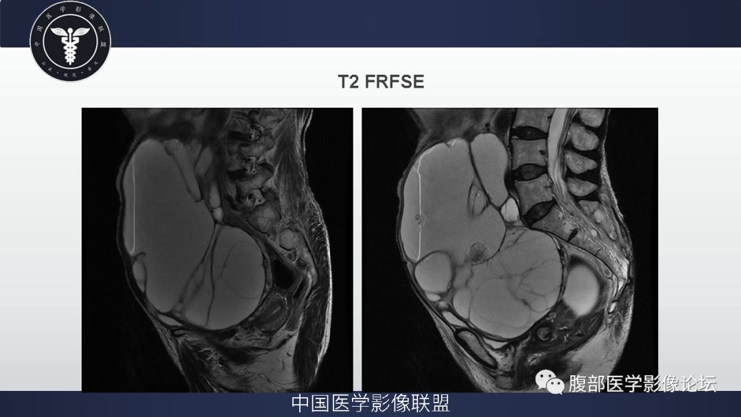 卵巢粘液性囊腺癌图片