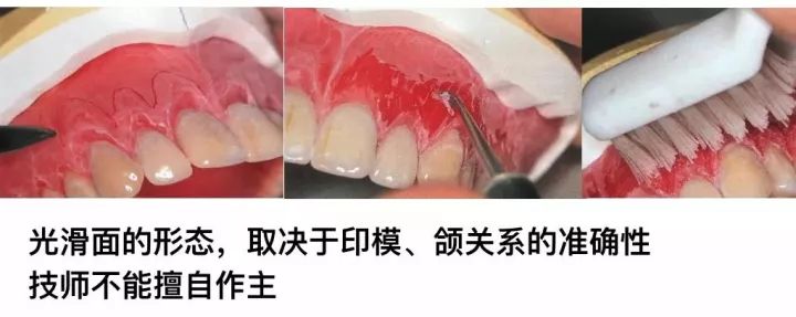 全口义齿蜡型制作步骤图片
