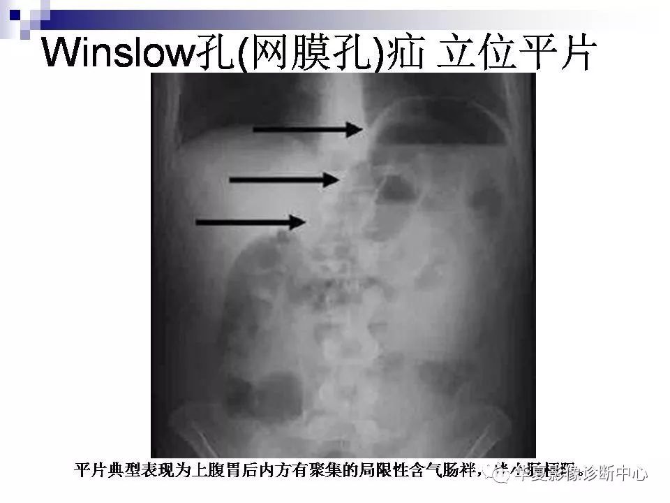 腹脂线影像图片位置图片