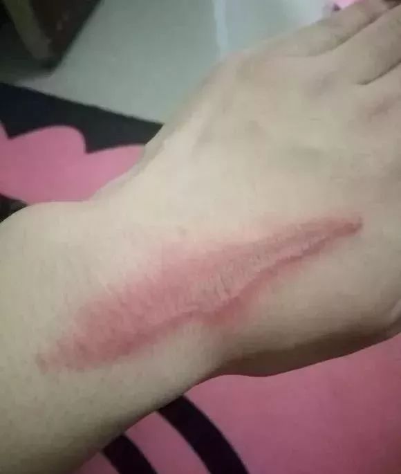 但下面这种就厉害了,是没有毒性的,上面说的这种虫子"蠼螋"(3)化学