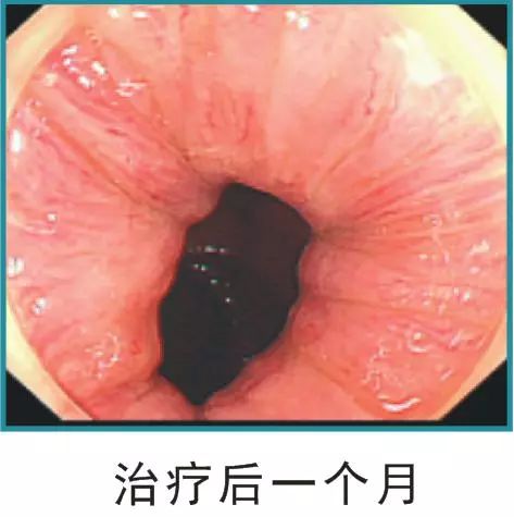 透明帽辅助内镜下硬化术,是一种肠镜下硬化剂治行内痔的微创技术,即在