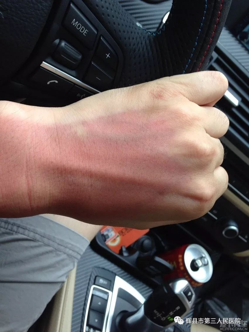 炎炎夏日怎样预防日晒伤