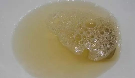 早晨小便尿里太多泡泡当心尿毒症袭来二多一少要记住