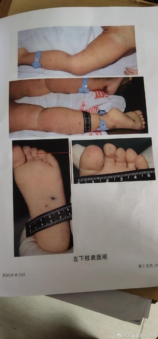 1岁多女童由父亲出轨对象照看时死亡警方不予立案