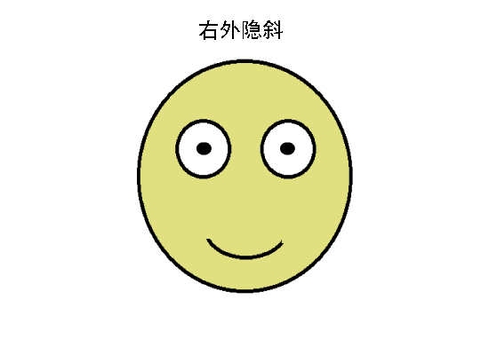 外隐斜一般看不出来,只有在遮挡时,眼球才会出现外斜,一去掉遮盖,眼球