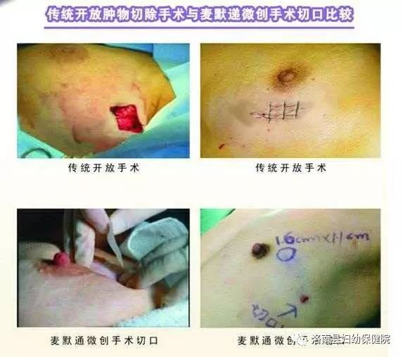 乳房手术全过程图片
