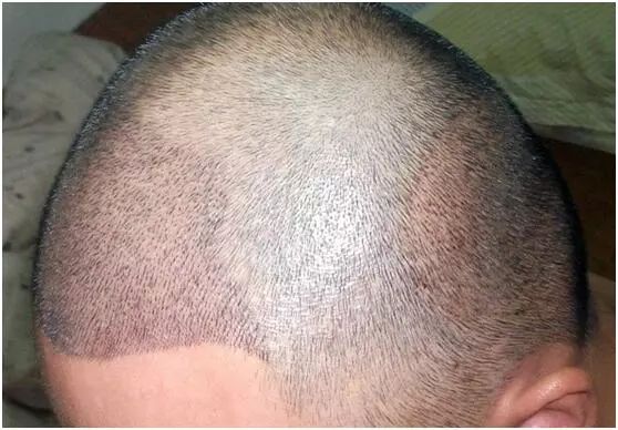 3500单位前额植发,见证我的术后效果!