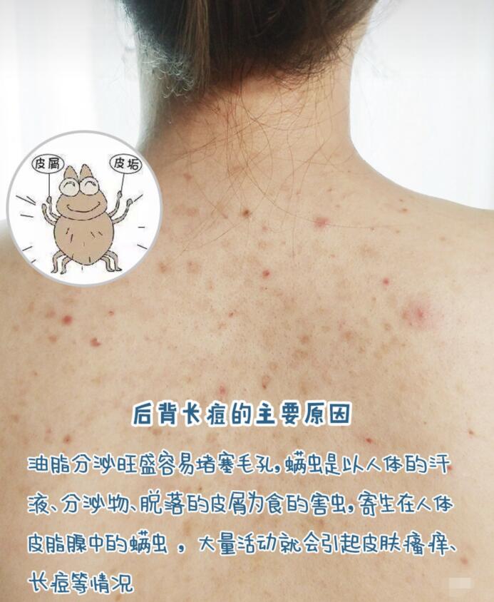 后背长痘痘是什么原因图片