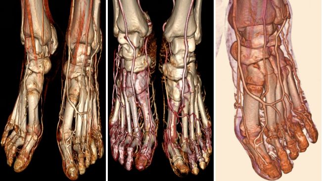 单圈不动床容积扫描完成低剂量全足cta扫描, 足背血管网及足底动脉弓