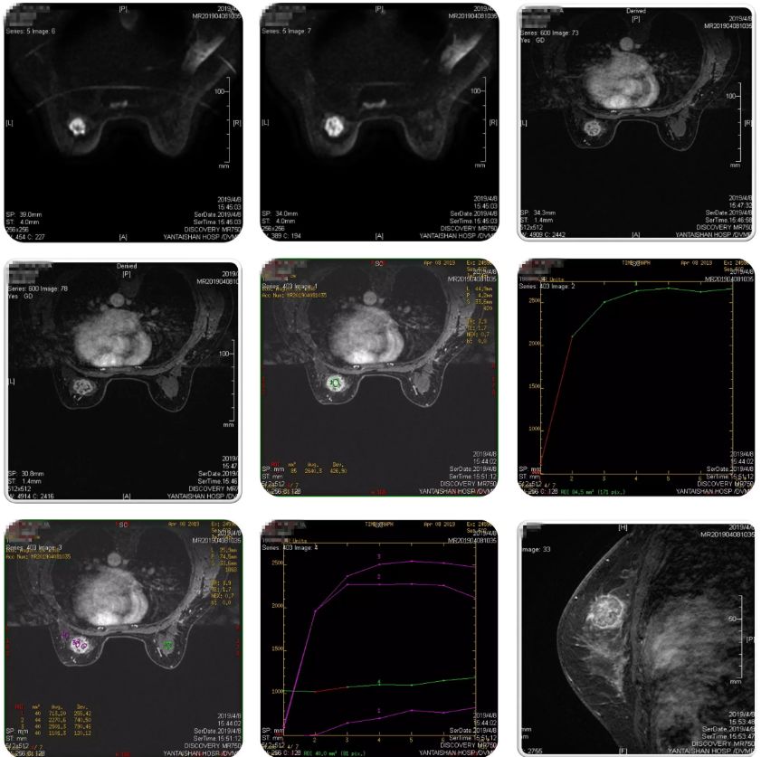 乳腺mri:左側乳腺內上象限近中線區可見類圓形腫塊,呈稍長t1稍長t2