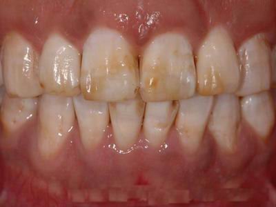 4,根管治疗过的牙齿,没有牙髓营养供应,牙齿逐渐变得暗黄