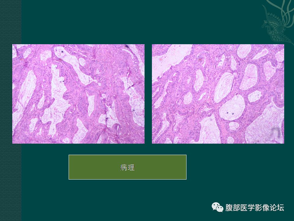 左側卵巢腫物卵巢宮內膜樣腺癌高分化