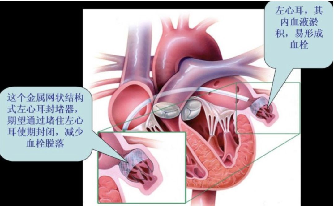 防止左心耳血栓形成及脱落,从血栓来源的源头上防止房颤卒中的发生