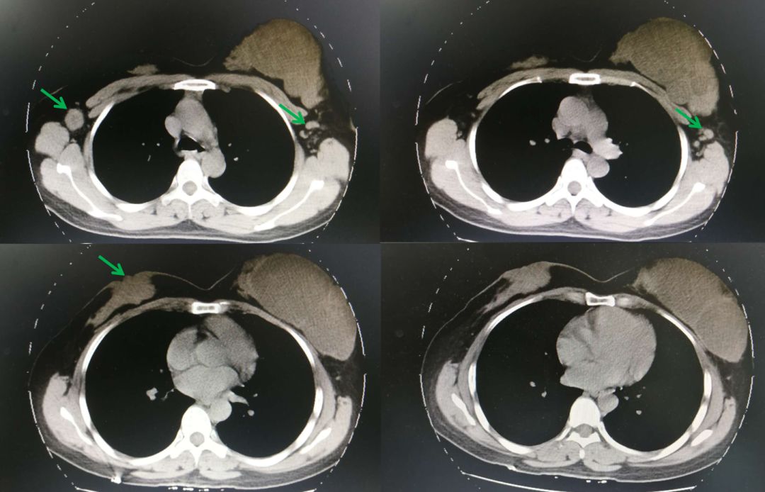 乳腺癌ct片图片图片