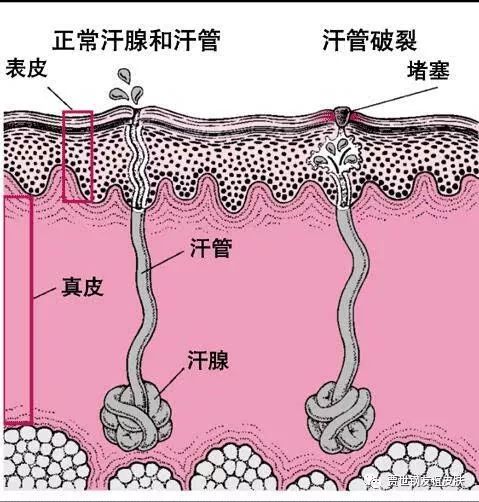 汗腺导管图片