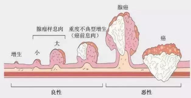 菜花型,寬基廣蒂息肉;1.