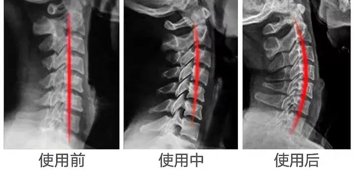 日本竟然还有这款护颈神器,轻松恢复颈椎自然曲度!