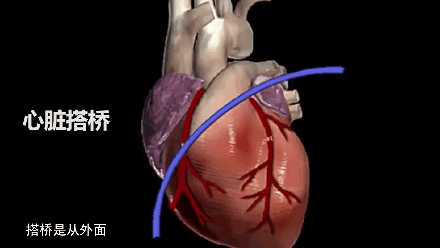 心脏支架动图图片