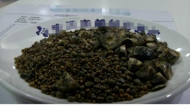 女子胆囊被塞满,取出7750颗结石!和这饮食习惯有关