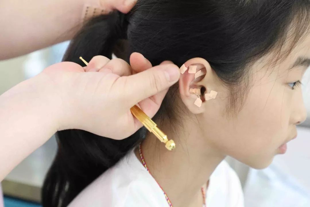 "耳穴埋豆法"学名又叫做"耳针疗法",此法具有简,便,廉,效的特点,操作